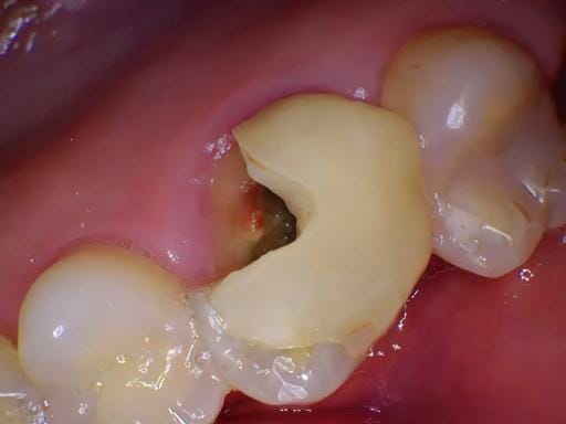 abcès dentaire provoquant un gonflement de la gencive à Tanger