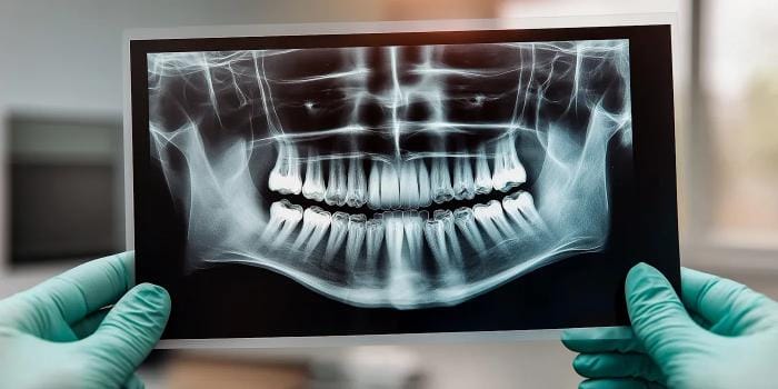 Radiographie panoramique dentaire tenue par un dentiste ganté