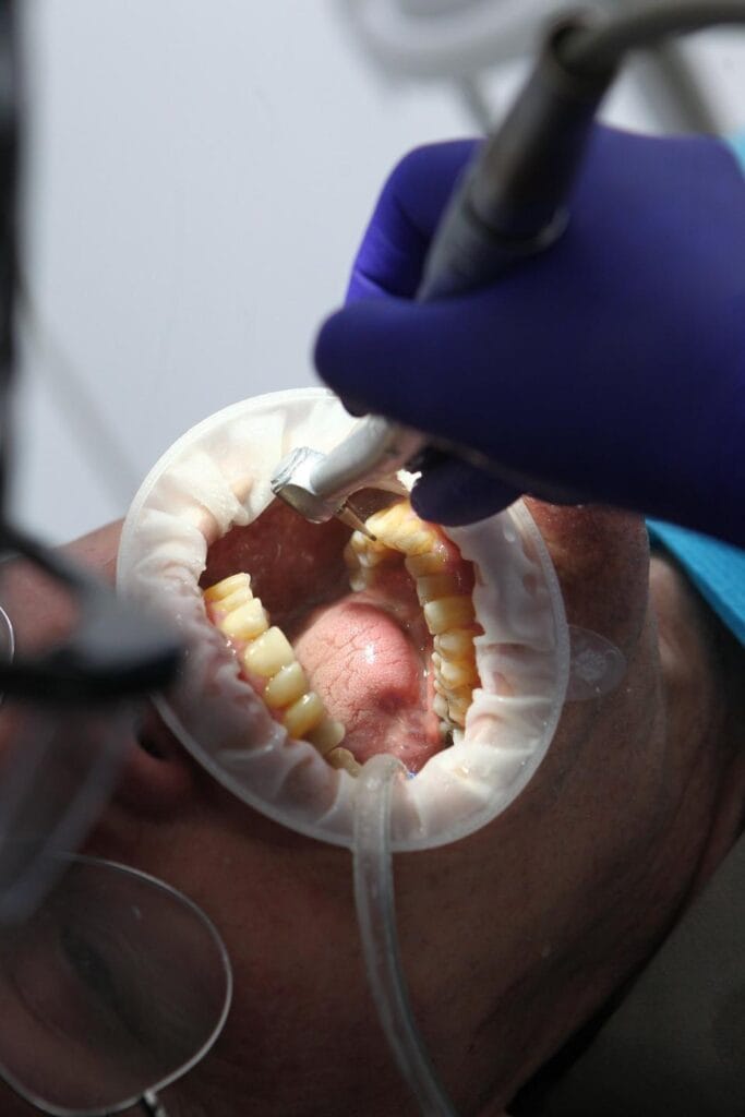 Curetage dentaire réalisé à Tanger au Divina Dental Center