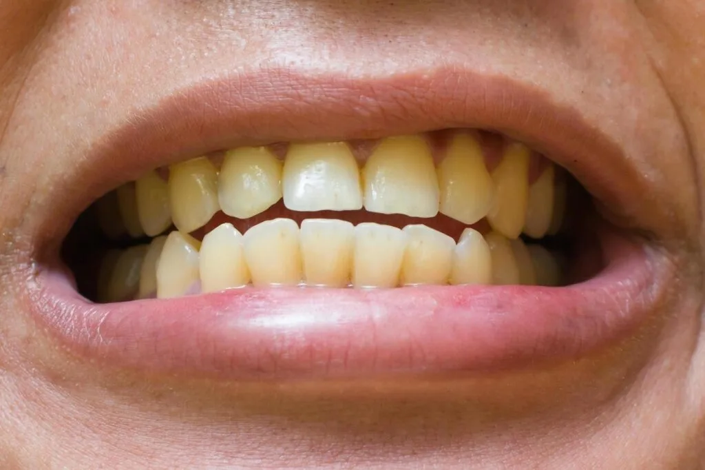 Dents jaunies visibles sur un sourire, avant un blanchiment dentaire