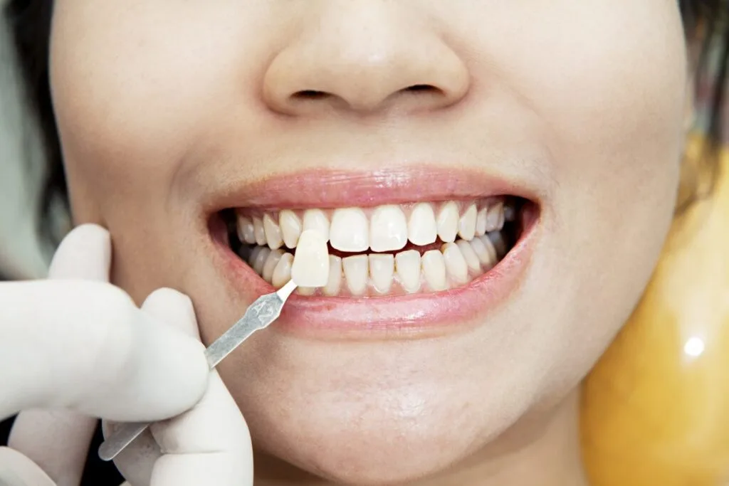 Contrôle de la teinte des dents avec un nuancier avant un blanchiment