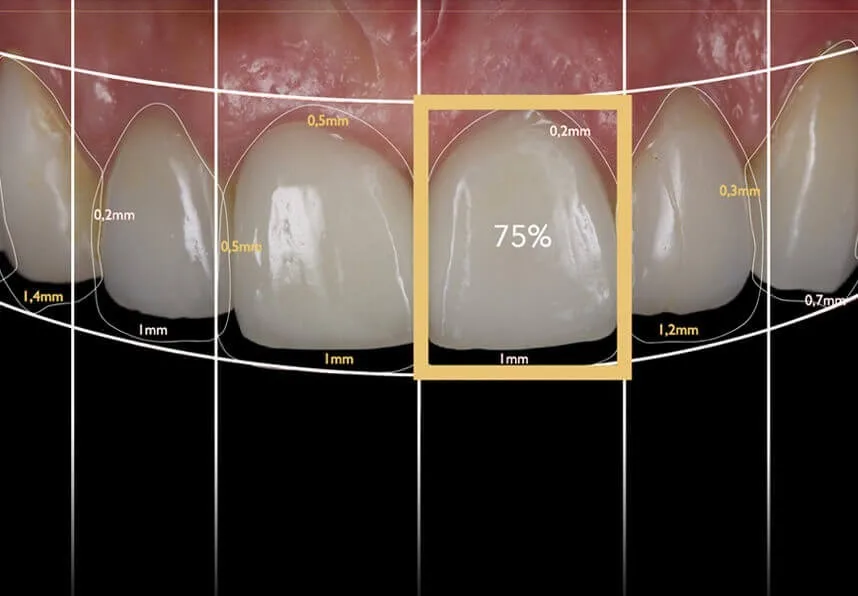 Analyse du smile design avec les proportions et les mesures des dents de devant