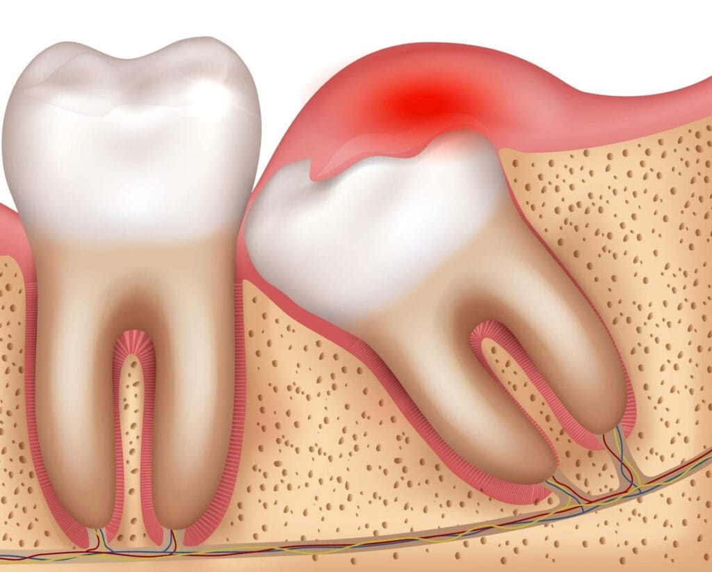Dent de sagesse incluse et infection de la gencive illustrées