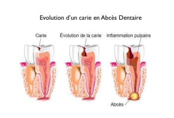 Évolution d'une carie en abcès dentaire en trois étapes