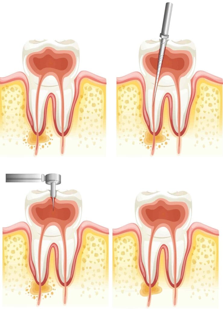 Étapes du traitement endodontique d'un abcès dentaire