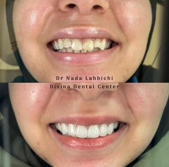 Facettes dentaires sur dents mal alignées, dentiste à Tanger
