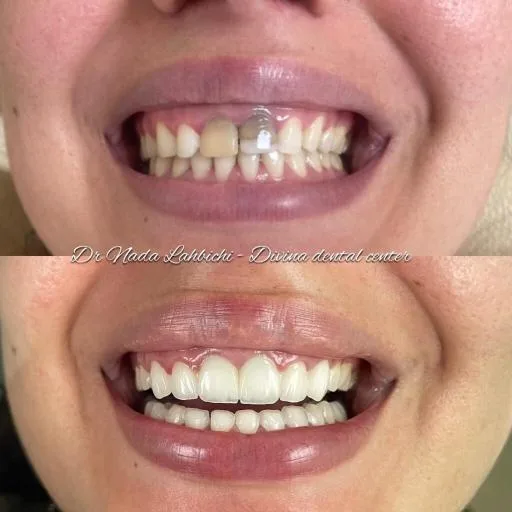 Résultat avant et après un traitement esthétique dentaire par le Dr Nada Lahbichi au Divina Dental Center à Tanger