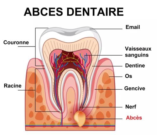 Schéma d'un abcès dentaire : couronne, racine, nerf, os et gencive
