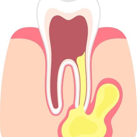 Illustration d'un abcès dentaire formé à la racine sous la gencive