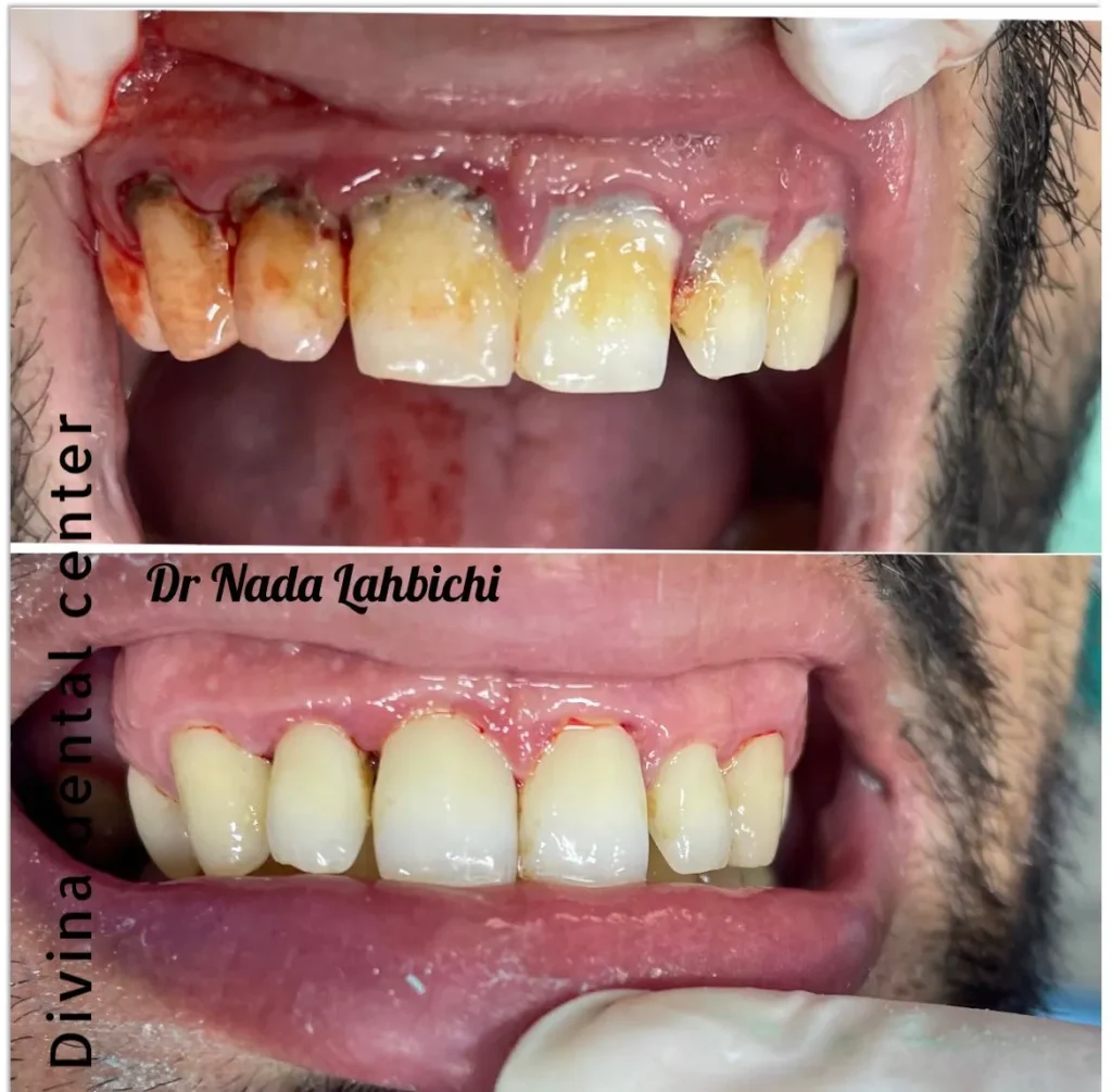 Avant après détartrage et surfaçage radiculaire sur des gencives enflammées au Divina Dental Center à Tanger