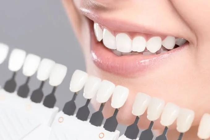 Teintier dentaire comparé à la teinte naturelle des dents