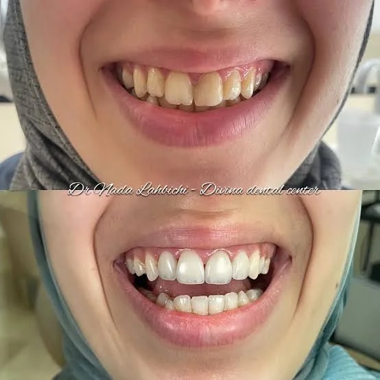 Avant et après un blanchiment dentaire réalisé par Dr Nada Lahbichi au cabinet Divina Dental Center à Tanger
