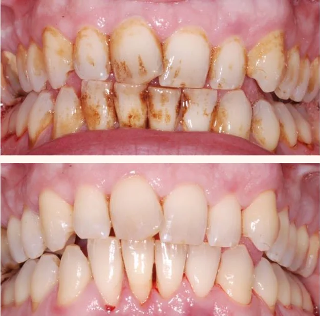 Avant et après un nettoyage dentaire professionnel : élimination des taches et colorations sur les dents