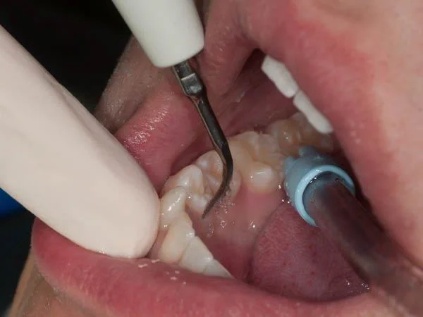 Détartrage dentaire aux ultrasons : nettoyage dentaire en gros plan réalisé par un médecin dentiste