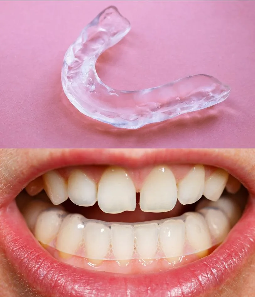 Gouttière transparente et sourire avec espacement dentaire avant traitement par aligneurs