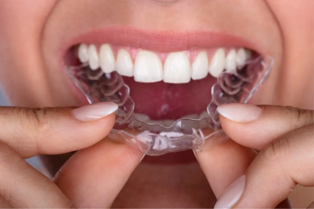 Mise en place d'un aligneur dentaire transparent sur les dents du bas