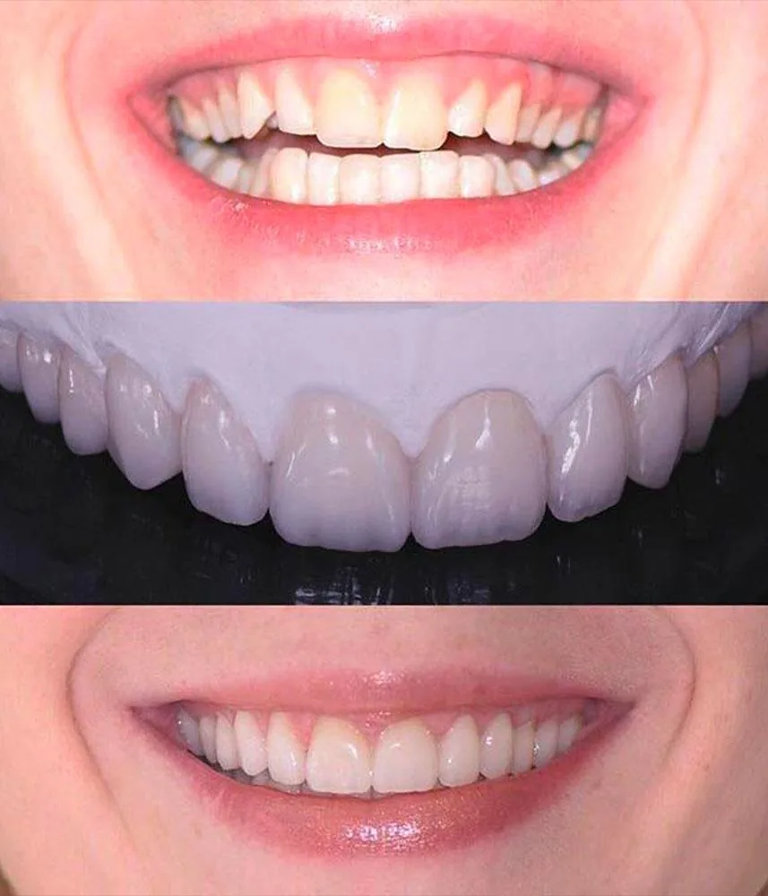 Comparaison avant et après la pose de facettes dentaires en céramique