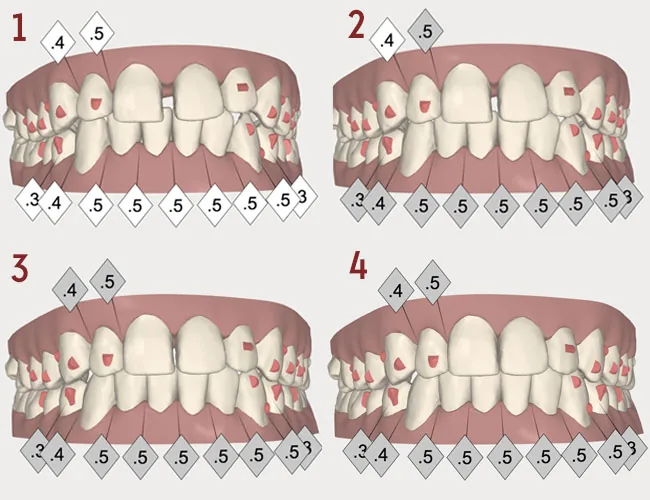 Simulation 3D des étapes d'un traitement Invisalign